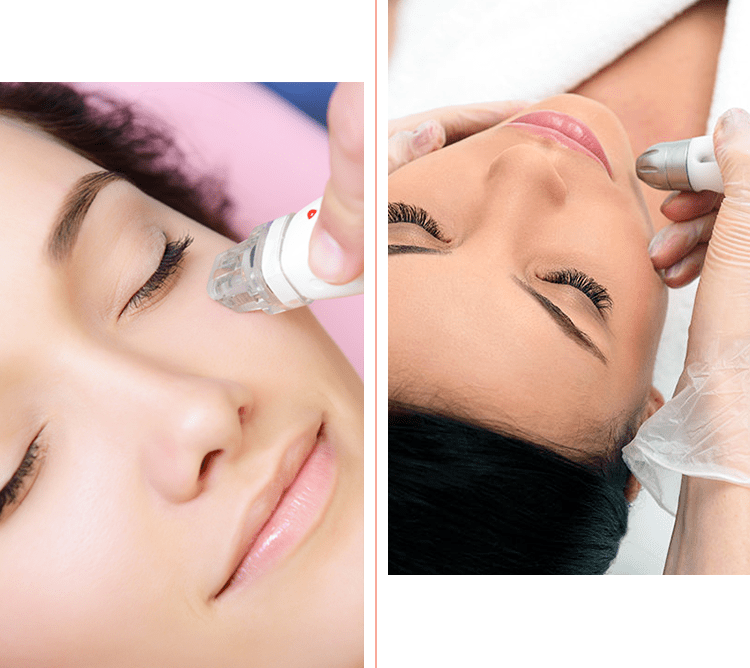 Microdermoabrasione viso con SkinPeel 3000 Chiasso